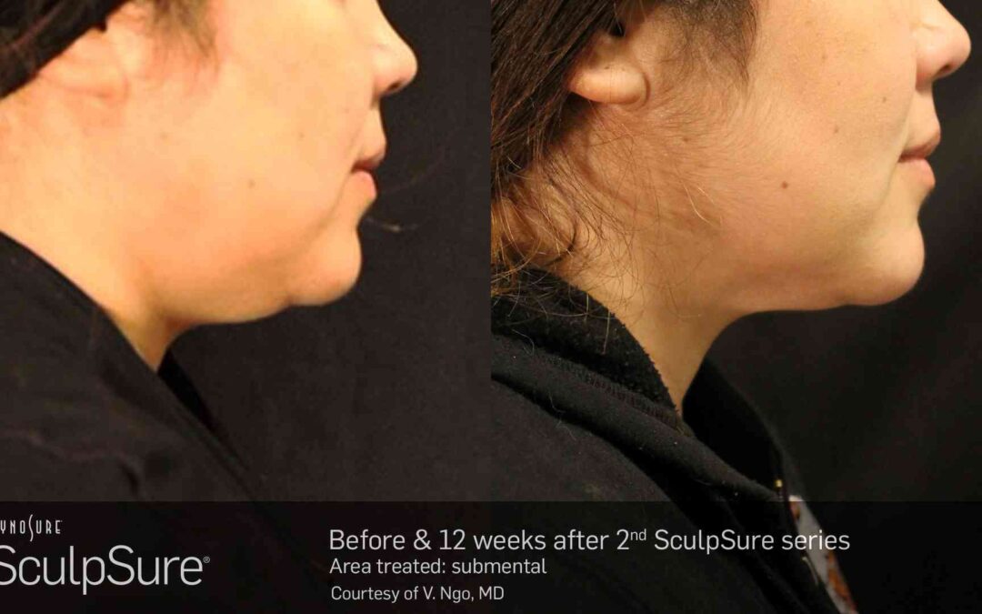 SculpSure before and after treatment
